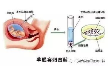 关于羊水穿刺科普