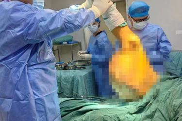 兰大二院骨科成功完成右侧大腿巨大脂肪肉瘤切除高难度手术