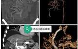 为门静脉完全栓塞患者“重启生命通道”——兰大二院消化内科实施省内首例EUS - TIPS