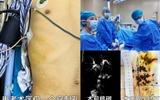 兰大二院普通外科独立完成省内首例PTOBF