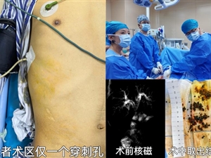 兰大二院普通外科独立完成省内首例PTOBF